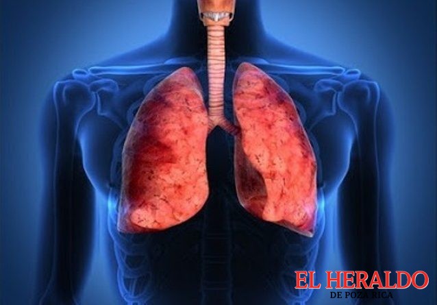 La tuberculosis