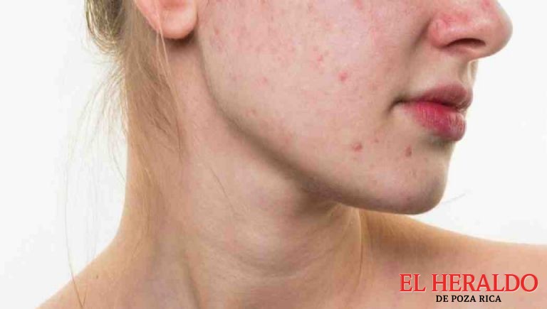 acne y manchas cultura 1